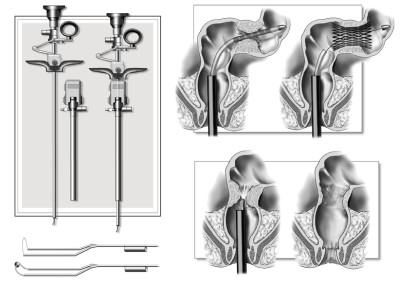 ENDOSCOPIC SURGERY - Ink and Digital 2003 – “Chirurgia dell’addome”, Elsevier-Masson